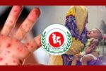 দেশে হাম উপসর্গে আরও ৮ শিশুর মৃত্যু