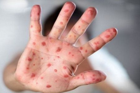 ২৪ ঘণ্টায় হাম ও হামের উপসর্গ নিয়ে ২৮ দিনে ১৬৯ শিশুর মৃত্যু